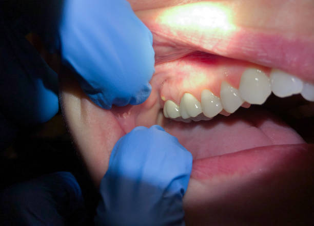 Best Emergency Tooth Extraction in Chatsworth, GA